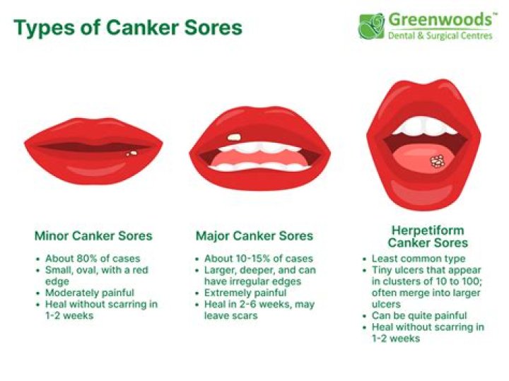 What is the white stuff in a canker sore?
