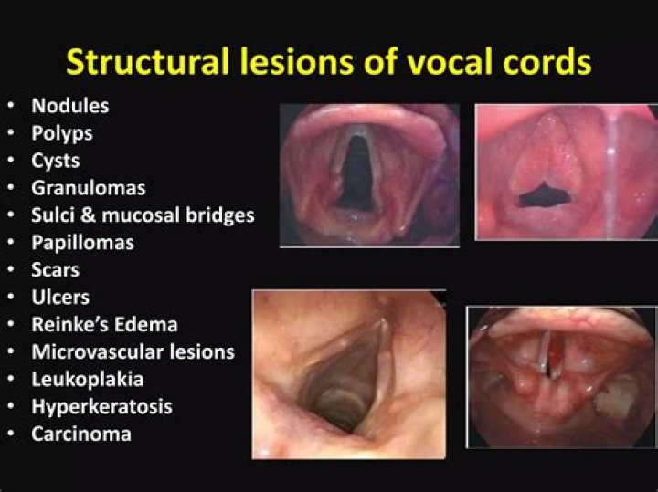 What is vocal cord leukoplakia?