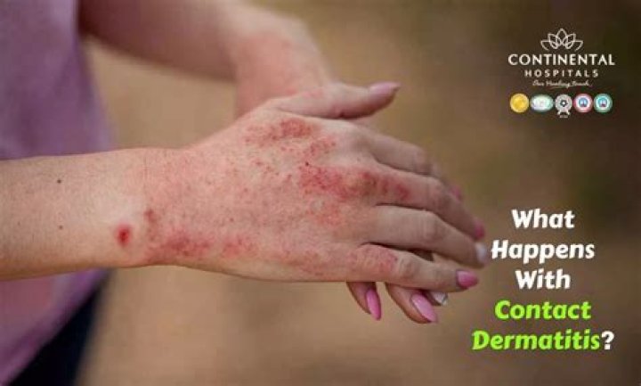 What kills contact dermatitis?