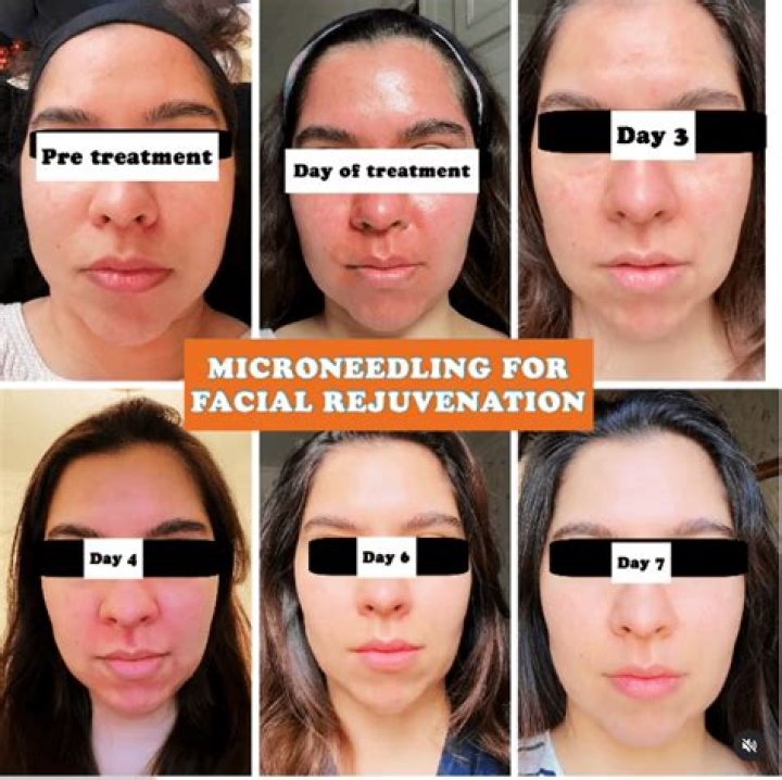 What moisturizer can I use after microneedling?