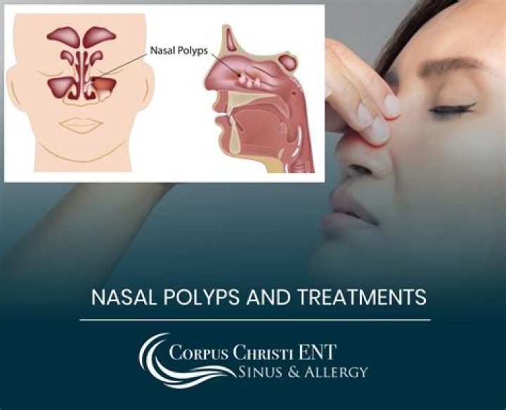 What nasal spray gets rid of polyps?