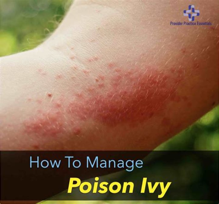 What oozes out of poison ivy blisters?
