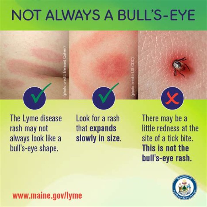 What other bug bites cause bullseye rash?