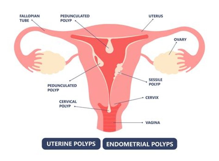 What percentage of uterine polyps are malignant?