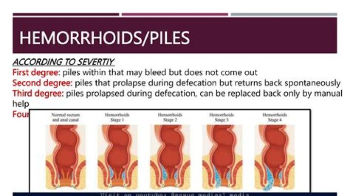 What pills help with hemorrhoids?