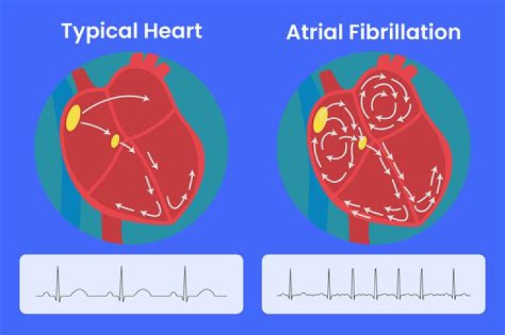 What should you not do if you have atrial fibrillation?