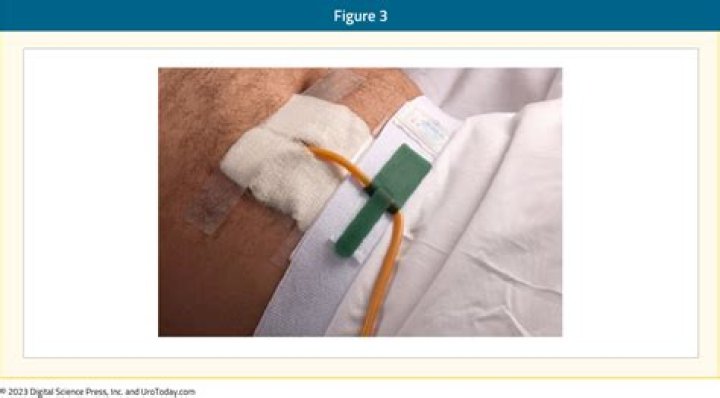 What should you not drink with a catheter?