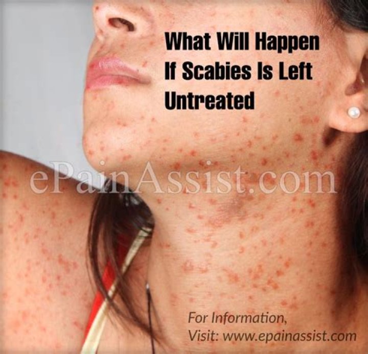 What will happen if scabies is left untreated?