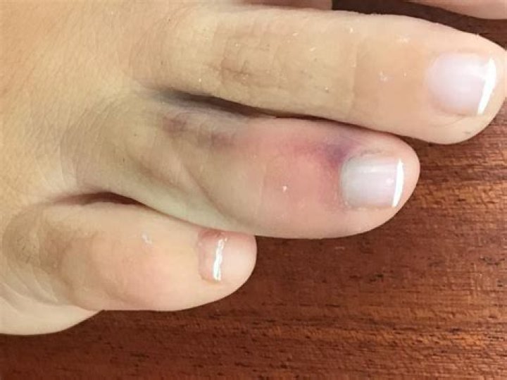 What's a broken toe look like?
