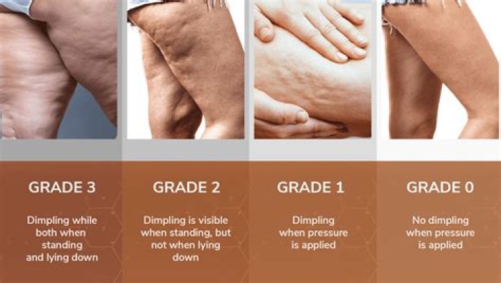 What's good for cellulite on thighs?