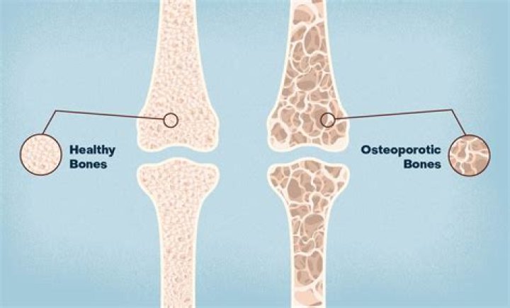 What's worse osteoarthritis or osteoporosis?