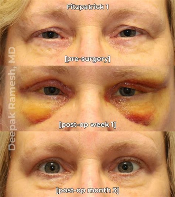 When can I drive after eyelid surgery?