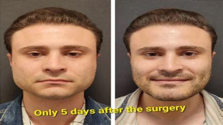 When can I eat pizza after jaw surgery?