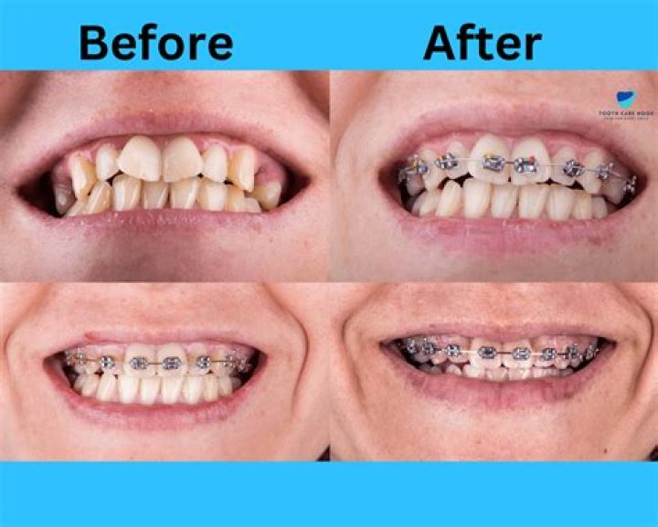 When will my braces stop cutting me?