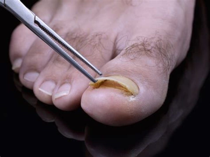 Where does toenail fungus come from?