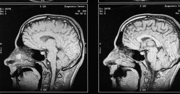 Which nerve causes tinnitus?