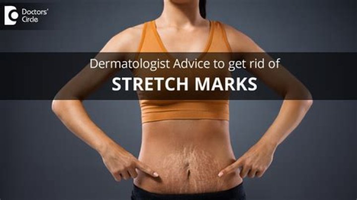 Which oil can remove stretch marks?