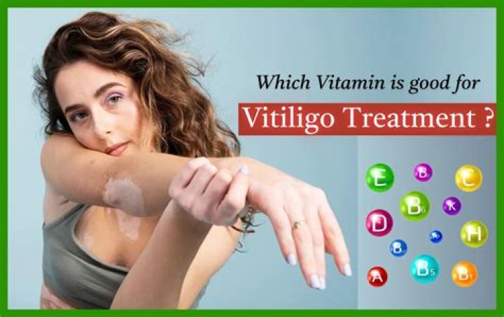 Which vitamin is good for vitiligo treatment?