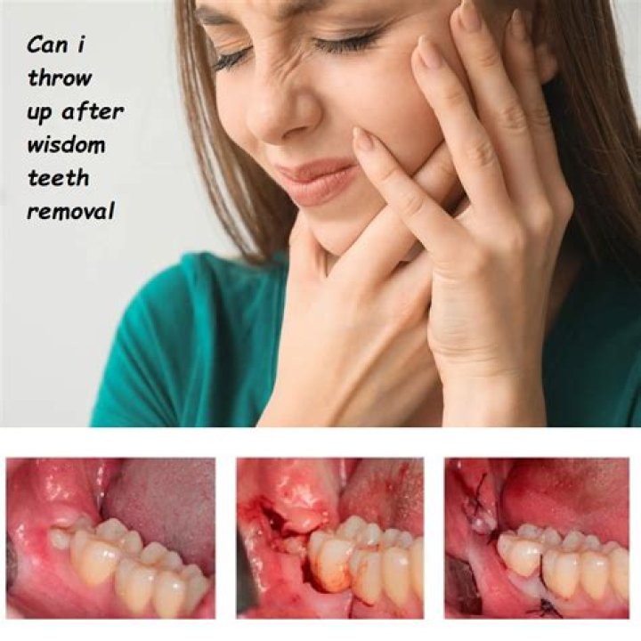 Why can't I smile after wisdom teeth removal?