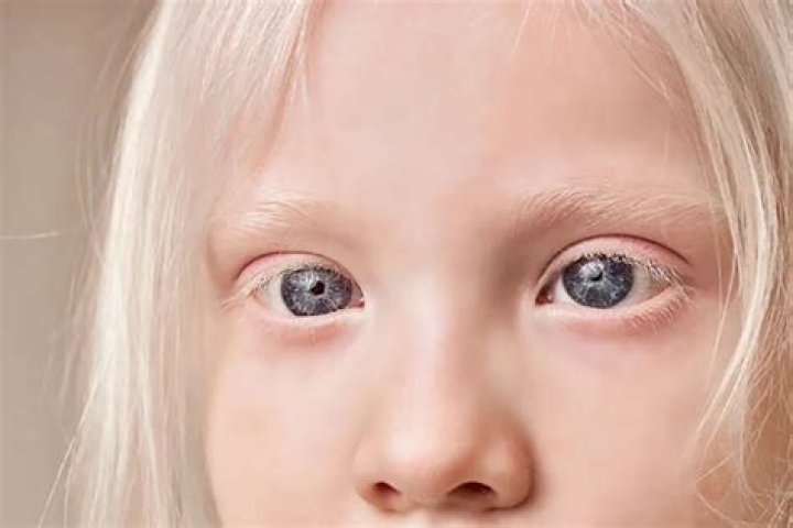 Why do albinos eyes shake?
