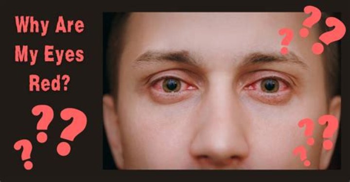 Why do alcoholics have red eyes?