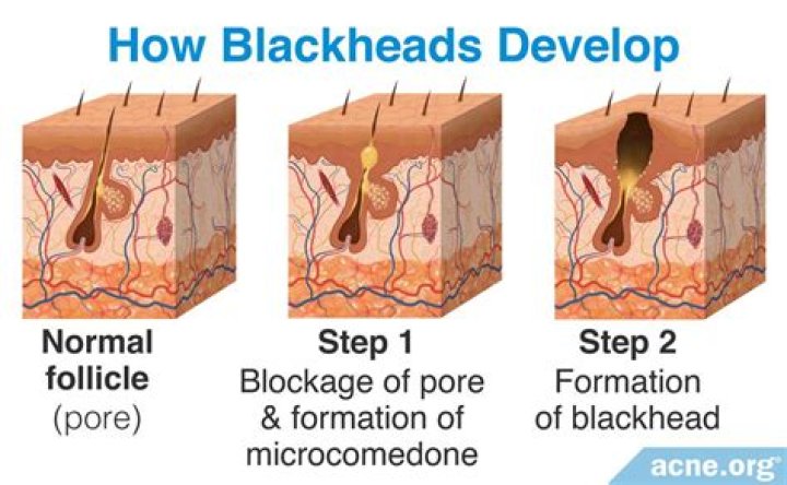 Why do blackheads look like worms?