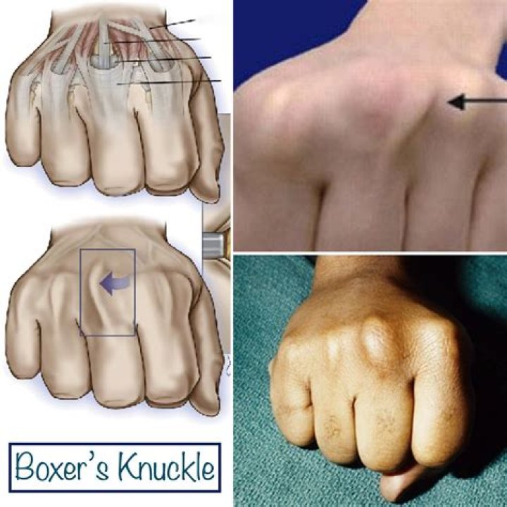 Why do boxers hands break?
