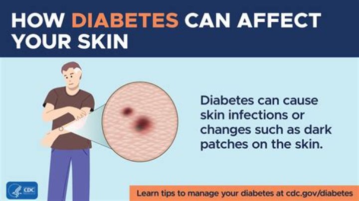 Why do diabetics skin get so dry?