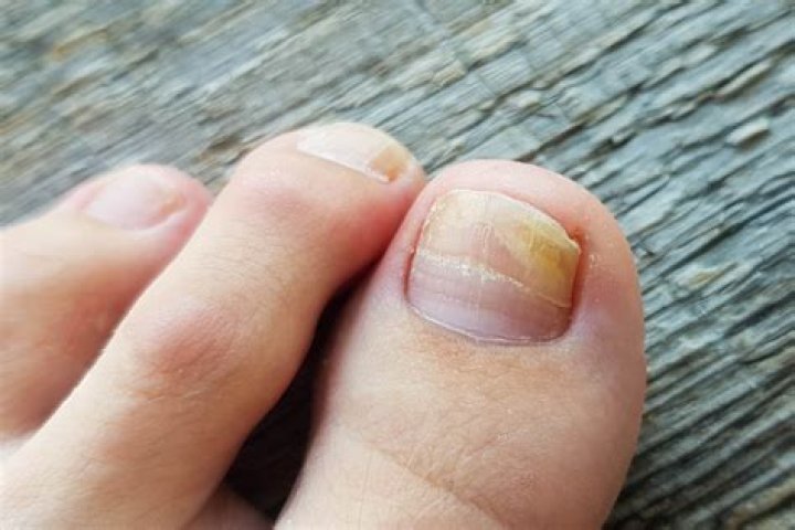 Why do I have double toenails?