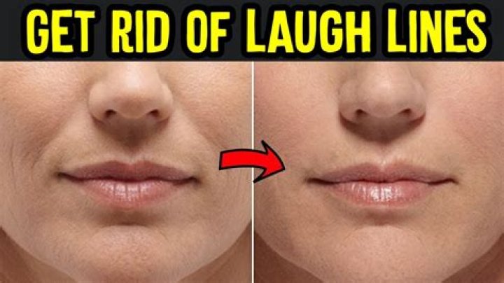 Why do I have laugh lines at 14?