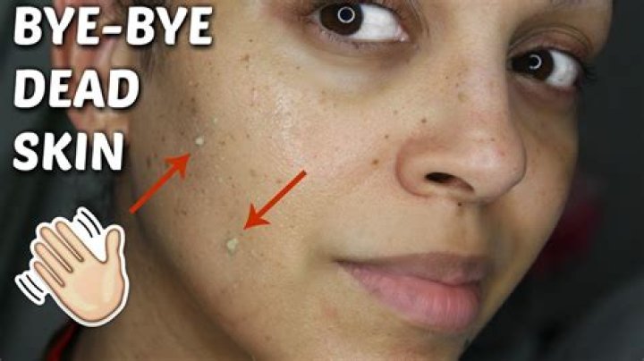 Why do I have so much dead skin on my face?