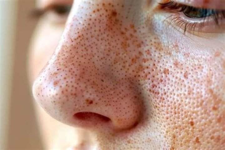 Why do my pores look like holes?