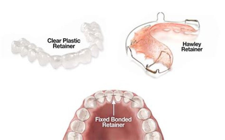 Why do retainers turn white?