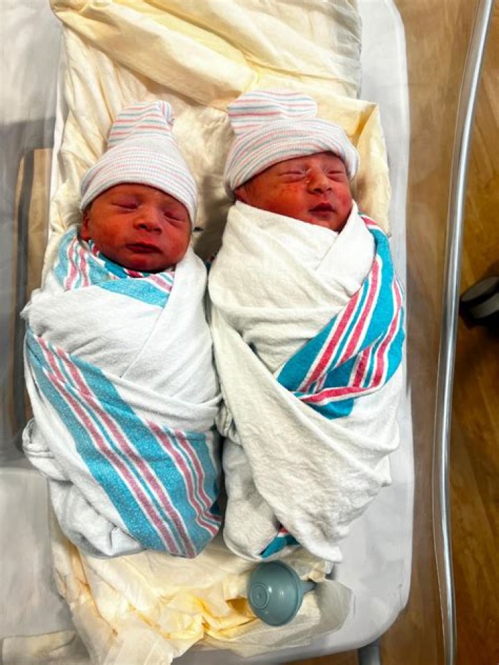 Why do stillborn babies look different?