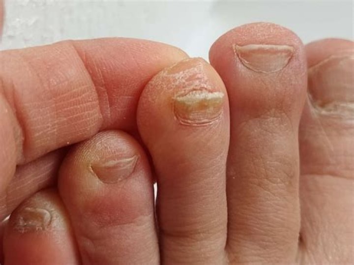 Why do toenails grow thick?