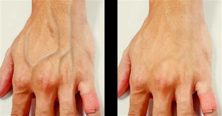 Why do veins pop out on feet?