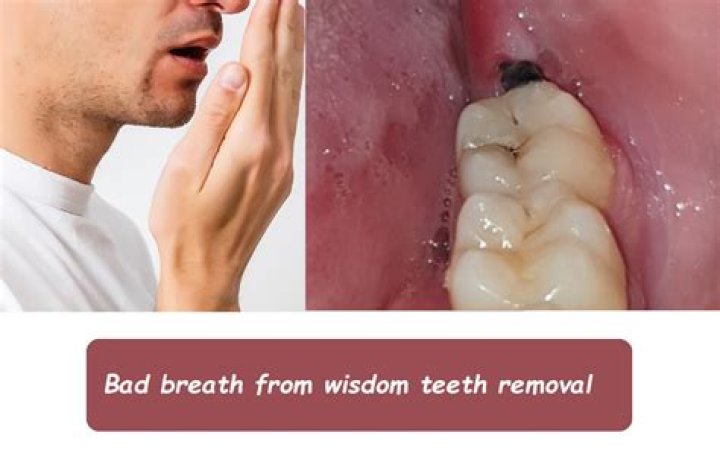 Why does my breath smell after wisdom teeth removal?