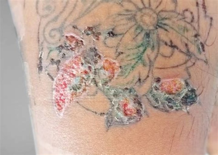 Why does my tattoo burn when I wash it?