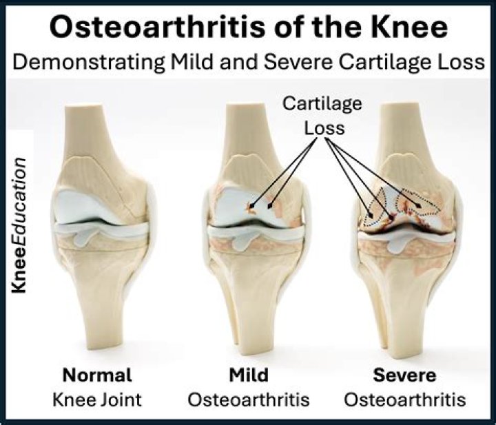 Why has my osteoarthritis suddenly got worse?