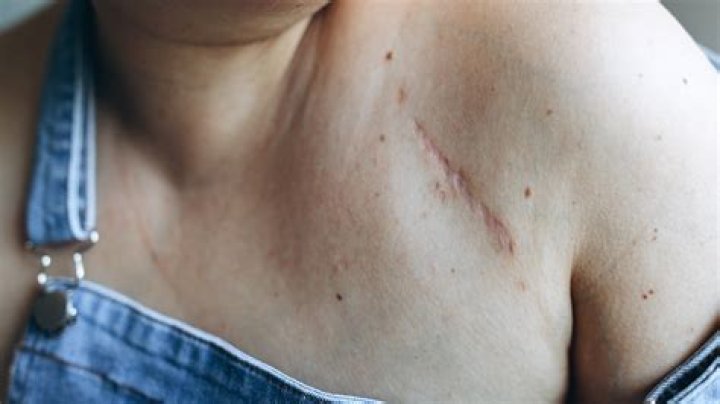 Why is it hard under my scar?