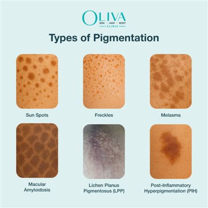 Why is my pigmentation getting worse?