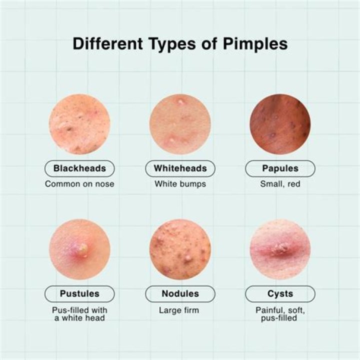 Why is my pimple purple After I popped it?