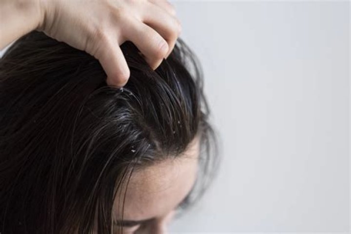 Why is my scalp oily and smelly?