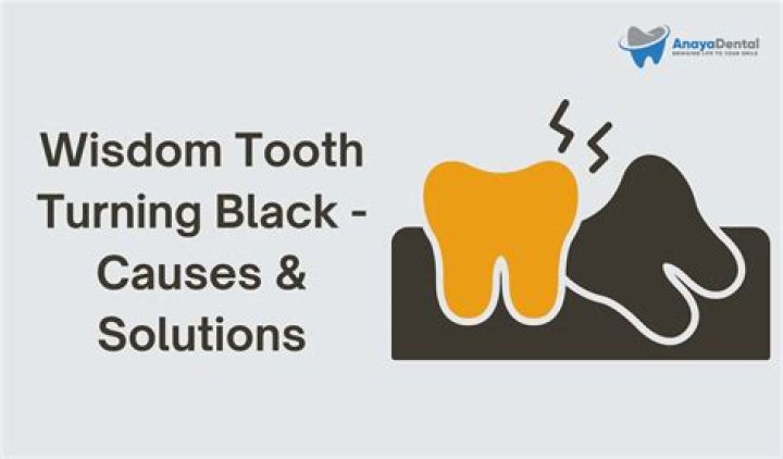 Why is my wisdom tooth black?