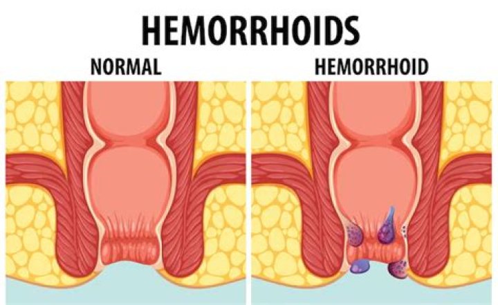 Why won't my hemorrhoid go away?