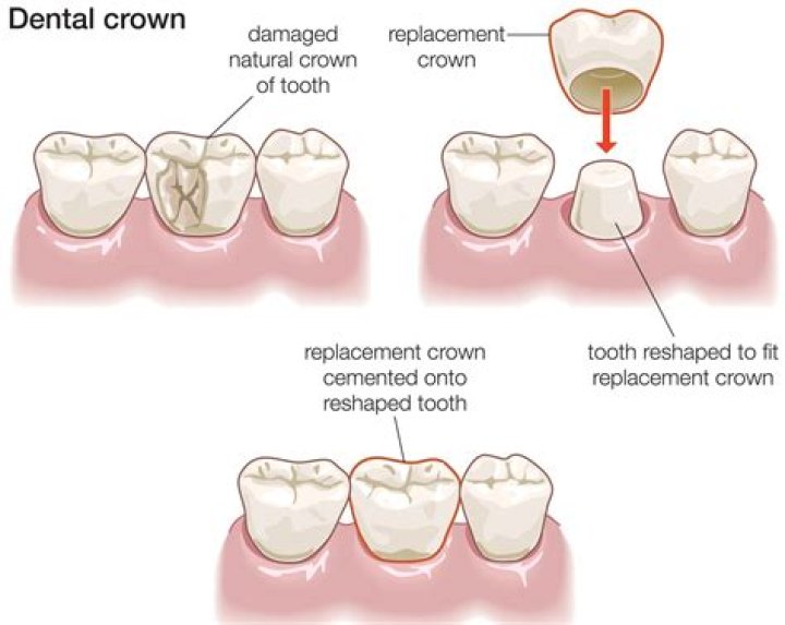 Why would a permanent crown fall off?