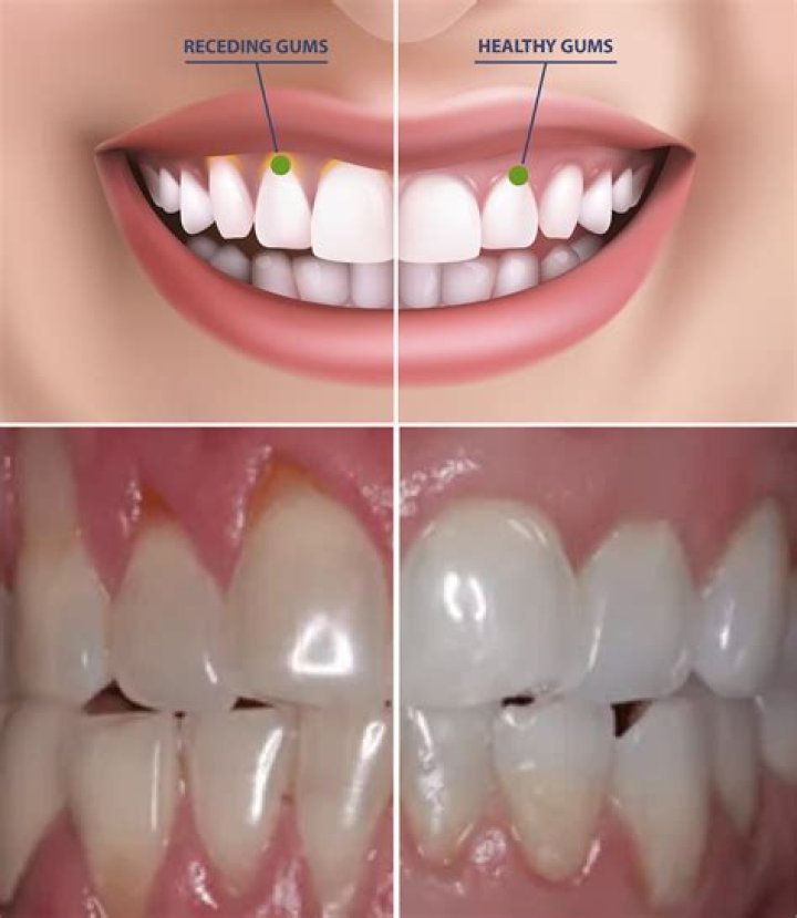 Will flossing help receding gums?