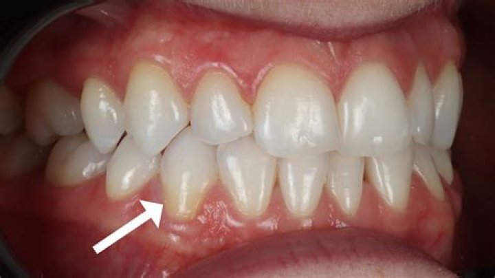 Will gums grow back over exposed bone?