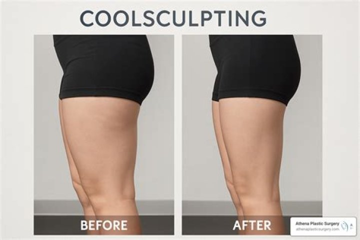Will skin sag after CoolSculpting?