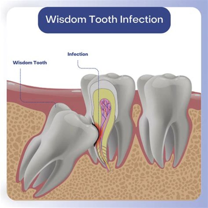 Will tooth infection come back after antibiotics?